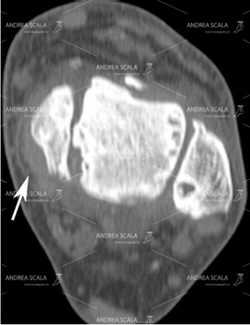 9 Questa proiezione assiale della caviglia è molto accurata e mette in evidenza l’artrosi.