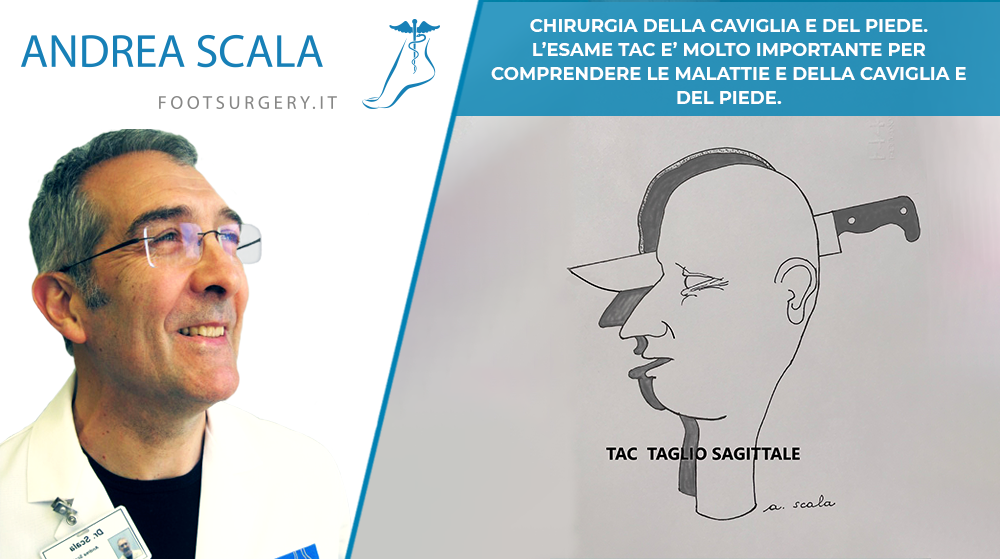 CHIRURGIA DELLA CAVIGLIA E DEL PIEDE. L’ESAME TAC E’ MOLTO IMPORTANTE PER COMPRENDERE LE MALATTIE E DELLA CAVIGLIA E DEL PIEDE.