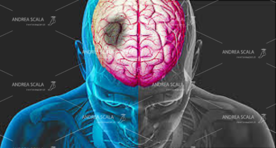 Lo schema mostra dove si verifica il danno cerebrale che può essere conseguente alla emorragia oppure alla ischemia