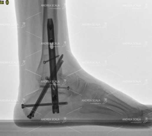 La radiografia mostra l’ARTRODESI. la caviglia di questo paziente è stata bloccata per sempre. E’ stato usato un grande chiodo che dalla pianta del piede arriva fino alla tibia. 