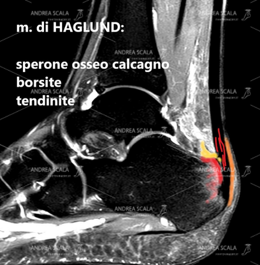 La immagine di Risonanza magnetica mostra le tre componenti del m. di Haglund.