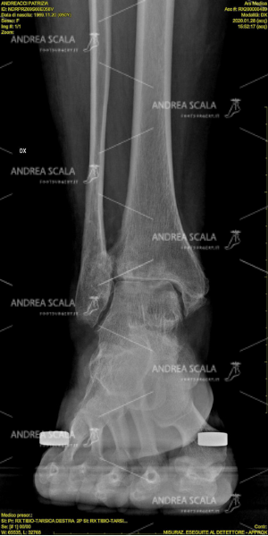 La RXgrafia mostra l’artrosi della caviglia.