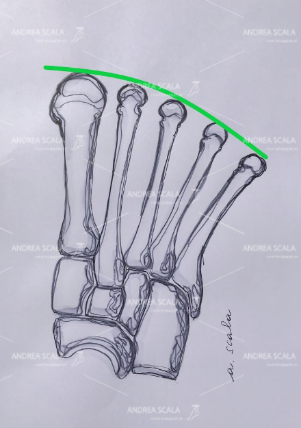 Normalmente il 1° metatarsale è allo stesso livello del 2°. Questo consente la normale anatomica e regolare distribuzione del peso corporeo nella fase d’appoggio e nella deambulazione.