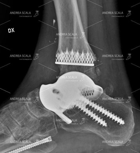 PROTESI DI CAVIGLIA PERSONALIZZATA
