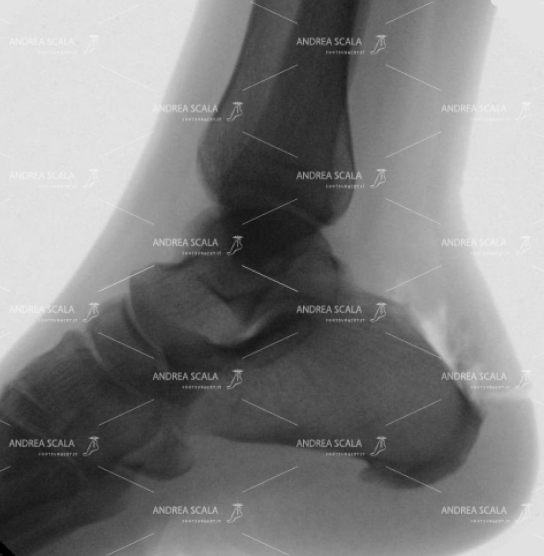 La sporgenza calcaneale viene asportata delicatamente in artroscopia. Nello spesso momento si aspira la borsite infiammata e si ripara il tendine d’Achille. Non c’è alcun bisogno di staccare il tendine d’Achille.