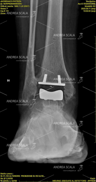 La RXgrafia mostra l’impianto della protesi di caviglia.