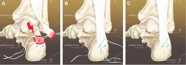Lo schema mostra l’intervento di staccare il tendine d’Achille, che viene poi riattaccato artificialmente. Il dott. Scala non esegue mai questo intervento.