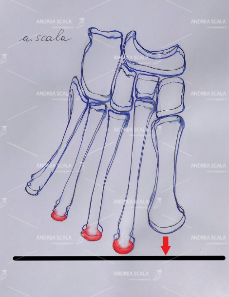 Nella fase propulsiva del passo, quando il piede si appoggia tutto sulla punta i metatarsi più lunghi soffrono molti perché devono sopportare un peso esagerato. Questa alterazione anatomica è la causa più comune e di più immediata comprensione della metatarsalgia. Il neuroma può insorgere nel corso della infiammazione dovuta alla metatarsalgia.