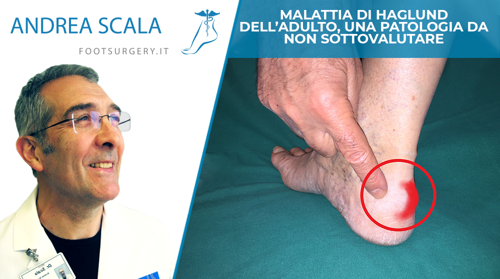 Malattia di Haglund dell’adulto, una patologia da non sottovalutare.