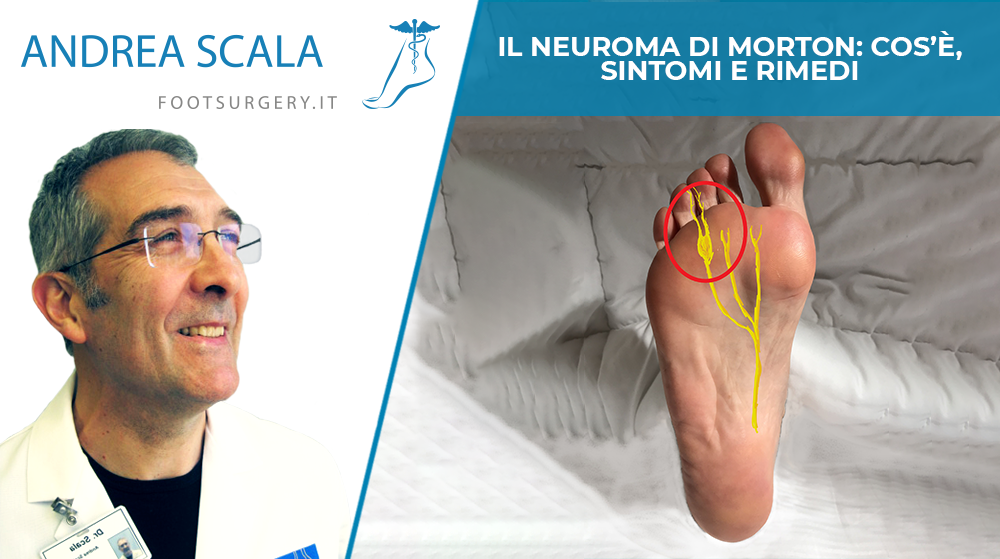 Il Neuroma di Morton