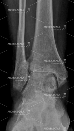 RXgrafia anteriore di grave artrosi della caviglia
