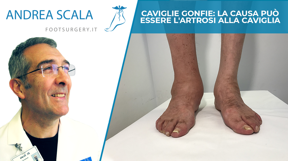 Caviglie gonfie: la causa può essere l’artrosi alla caviglia