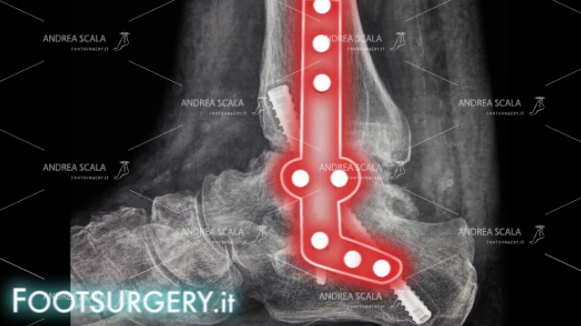 chirurgia-della-caviglia-dott-andrea-scala