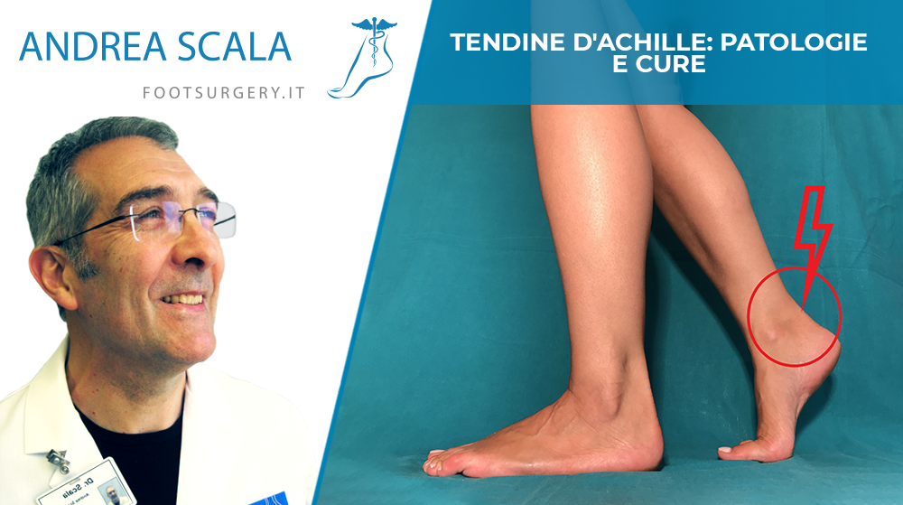 Tendine d’Achille: patologie e cure