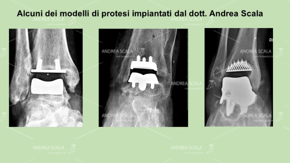 protesi-di-caviglia-dott-andrea-scala