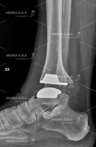 RXgrafia laterale di grave artrosi della caviglia in cui è stato eseguito l’impianto dei protesi della caviglia. Le parti malate della tibia e dell’astragalo sono state rimosse e rivestite con impianti metallici su misura. La protesi ripristina lo spazio articolare grazie all’inserto trasparente in polietilene.