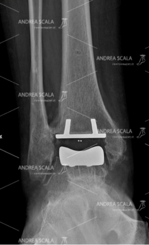RXgrafia anteriore di grave artrosi della caviglia in cui è stato eseguito l’impianto della protesi della caviglia. Le parti malate della tibia e dell’astragalo sono state rimosse e rivestite con impianti metallici su misura.