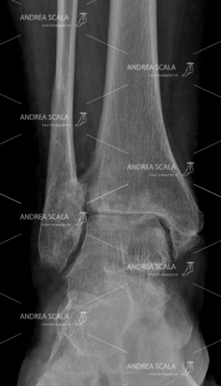 RX con visione anteriore della artrosi della caviglia