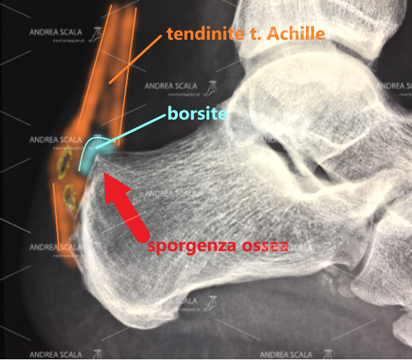 La malattia di Haglund è composta da: tendinite del t. d’Achille, borsite, sporgenza ossea postero superiore del calcagno.