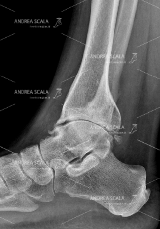 RX con visione anteriore della artrosi della caviglia
