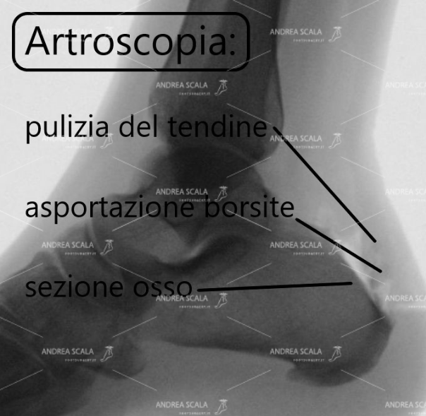 L’artroscopia della malattia di Haglund elimina le tre componenti della malattia senza nessun bisogno di staccare il tendine.