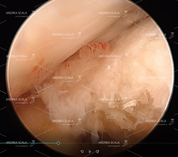 a) l’artroscopia mostra la sporgenza del calcagno, la inserzione del tendine d’Achille e la borsite con i capillari;