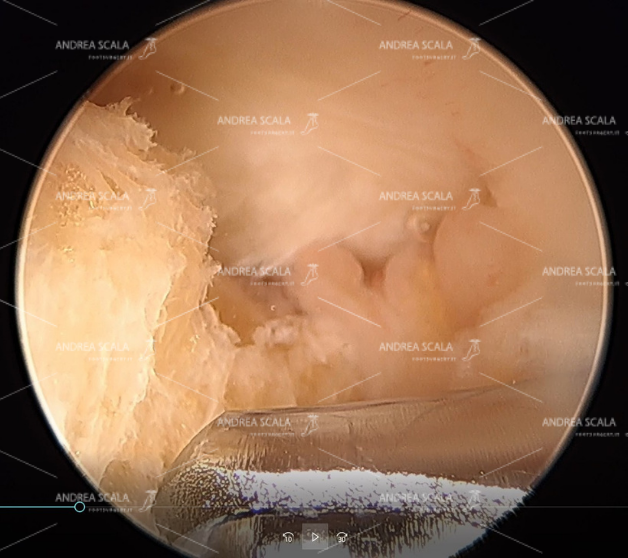 b) si vede il tendine d’Achille, la borsite e la fresa motorizzata che ha iniziato la resezione del calcagno;