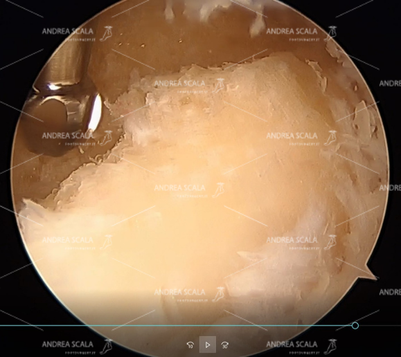 d) si vede la fresa motorizzata che prosegue la resezione del calcagno