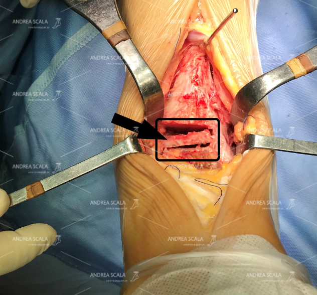 La foto mostra lo spazio che si deve creare nella caviglia (indicato nel riquadro) per consentire l’impianto della protesi. La freccia indica il frammento di astragalo (4 mm) che viene asportato.