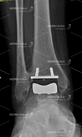 RX con visione anteriore della protesi della caviglia