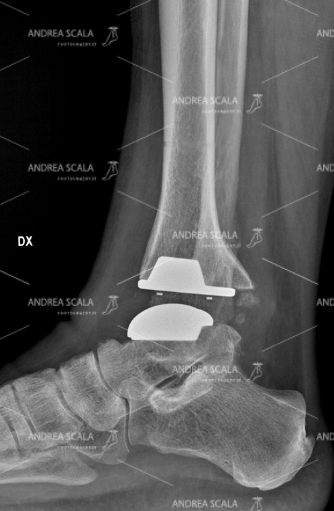 RX con visione laterale della protesi della caviglia