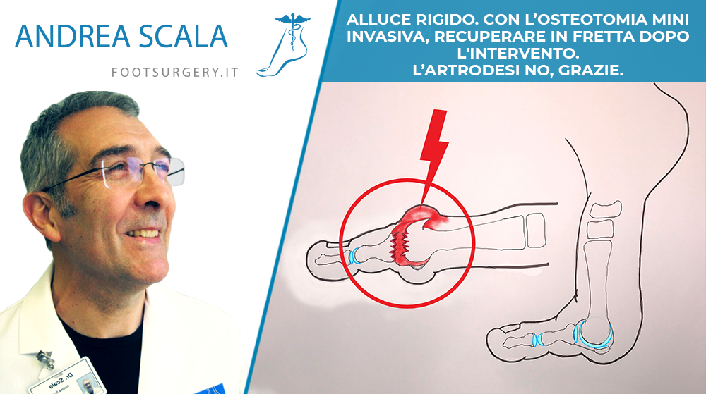 Alluce rigido. Con l’osteotomia mini invasiva, recuperare in fretta dopo l’intervento. L’artrodesi no, grazie.