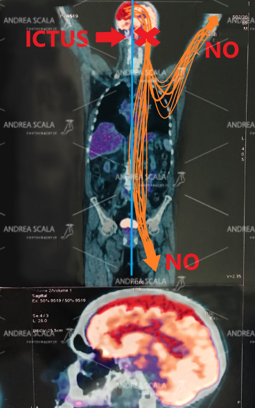 SISTEMA-NERVOSO-INTERROTTO-post-ictus-4.jpeg