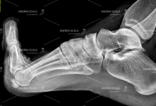 La RXgrafia mostra che nelle normali condizioni la mobilità dell’alluce raggiunge i 90 gradi.