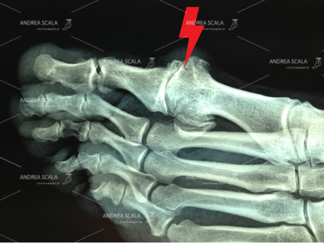 La RXgrafia mostra la grave artrosi dell’alluce. L’articolazione è scomparsa e le ossa si toccano. Si nota il voluminoso sperone osseo in sede dorsale. L’alluce non si può muovere