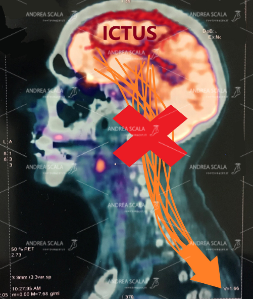 cervello-interrotto-post-icutus-3.jpeg