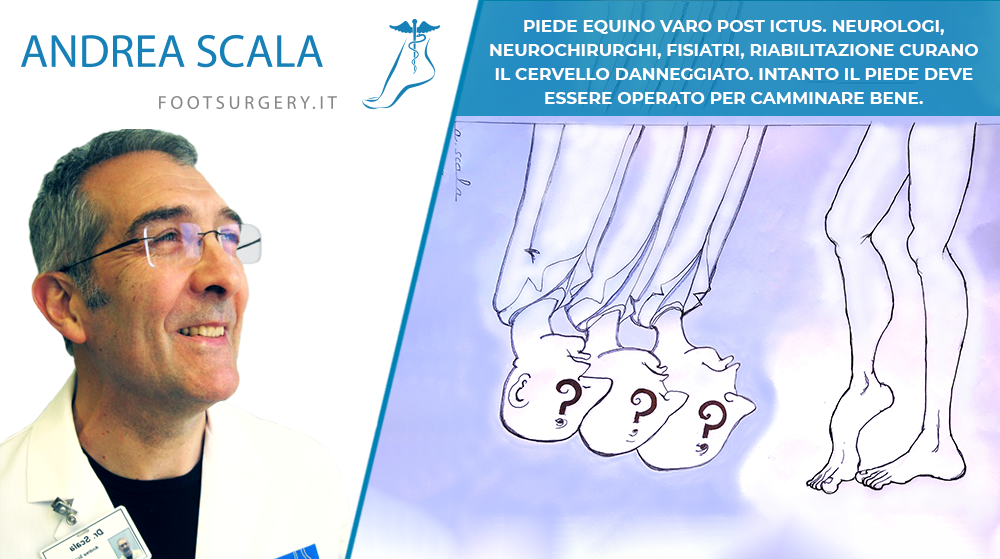 PIEDE EQUINO VARO POST ICTUS. NEUROLOGI, NEUROCHIRURGHI, FISIATRI, RIABILITAZIONE CURANO IL CERVELLO DANNEGGIATO. INTANTO IL PIEDE DEVE ESSERE OPERATO PER CAMMINARE BENE.