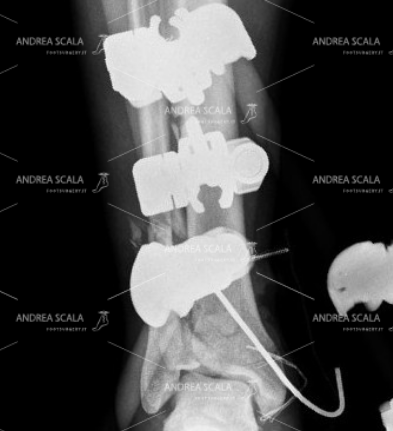 La RXgrafia mostra la visione anteriore della frattura della gamba e della caviglia (pilone tibiale). Si tratta di una frattura molto grave con danno delle ossa e delle parti molli.