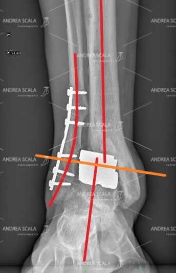 La RXgrafia mostra la visione anteriore della protesi della caviglia. Purtroppo il taglio del perone non è guarito bene e il perone è spostato verso l’esterno. Tutto il piede è spostato all’esterno, in valgo e non si trova sotto l’asse della tibia. La protesi è deviata esternamente come il piede. Il montaggio non è parallelo al suolo, ma è obliquo.