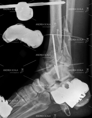 La RXgrafia mostra la visione laterale della frattura della gamba e della caviglia (pilone tibiale)
