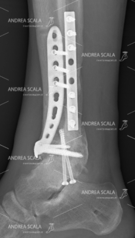 La RXgrafia mostra la visione laterale della frattura della gamba e della caviglia (pilone tibiale) che ha subito l’impianto della placche ed elle viti sulla tibia e sul perone.