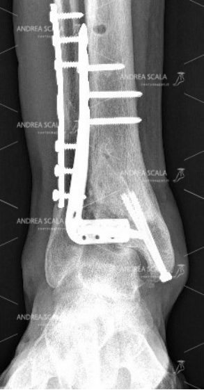 La RXgrafia mostra la visione anteriore della frattura della gamba e della caviglia (pilone tibiale) che ha subito l’impianto della placche ed elle viti sulla tibia e sul perone. Purtroppo la cartilagine si è schiacciata all’epoca della frattura e il paziente ha sofferto di blocco della articolazione e di grave dolore.