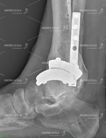 La RXgrafia mostra la visione laterale della protesi della caviglia.
