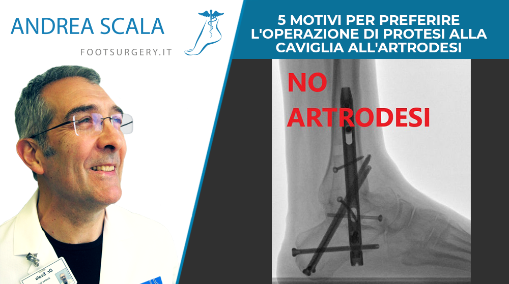 5 MOTIVI PER PREFERIRE L’OPERAZIONE DI PROTESI ALLA CAVIGLIA ALL’ARTRODESI