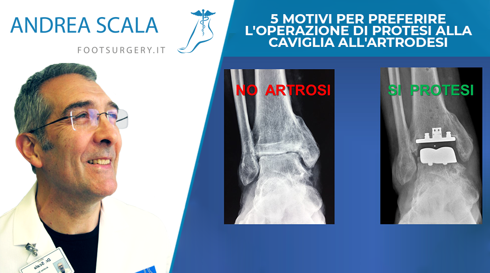 5 motivi per preferire l'operazione di protesi alla caviglia all'artrodesi