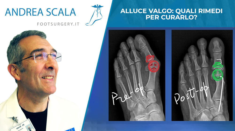 ALLUCE VALGO: QUALI RIMEDI PER CURARLO?