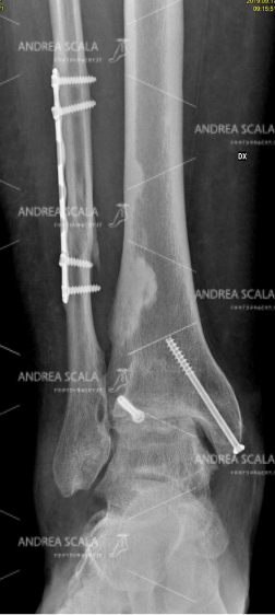 La RXgrafia anteriore della caviglia dopo 5 anni 6