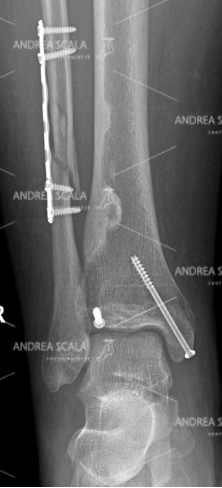 La RXgrafia anteriore mostra che la frattura tri-malleolare è stata operata con impianto di placca e viti. Il risultato post-operatorio è buono e l’articolazione sembra ben ricostruita.