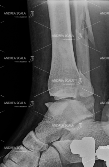 La RXgrafia laterale frattura tri-malleolare 3