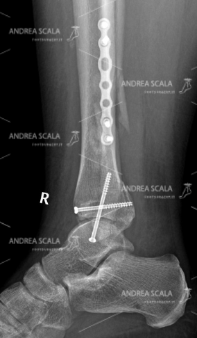 La RXgrafia laterale frattura tri-malleolare operata 5